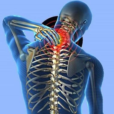 Bolečine v vratu z osteohondrozo materničnega vratu