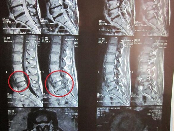 Diagnoza osteohondroze materničnega vratu