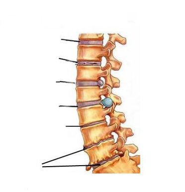 Kako se razvije osteohondroza