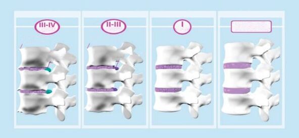 Stopnje osteohondroze materničnega vratu