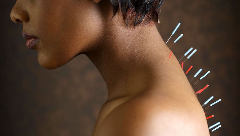 akupunktura z osteohondrozo materničnega vratu