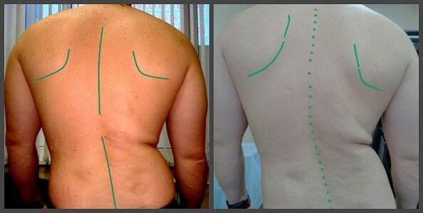 ukrivljenost hrbtenice z osteohondrozo