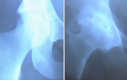 Skupna artroza kolenskega sklepa