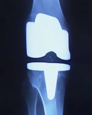 X -ray slika kolena z umetno protezo po operaciji za spremembo sklepa